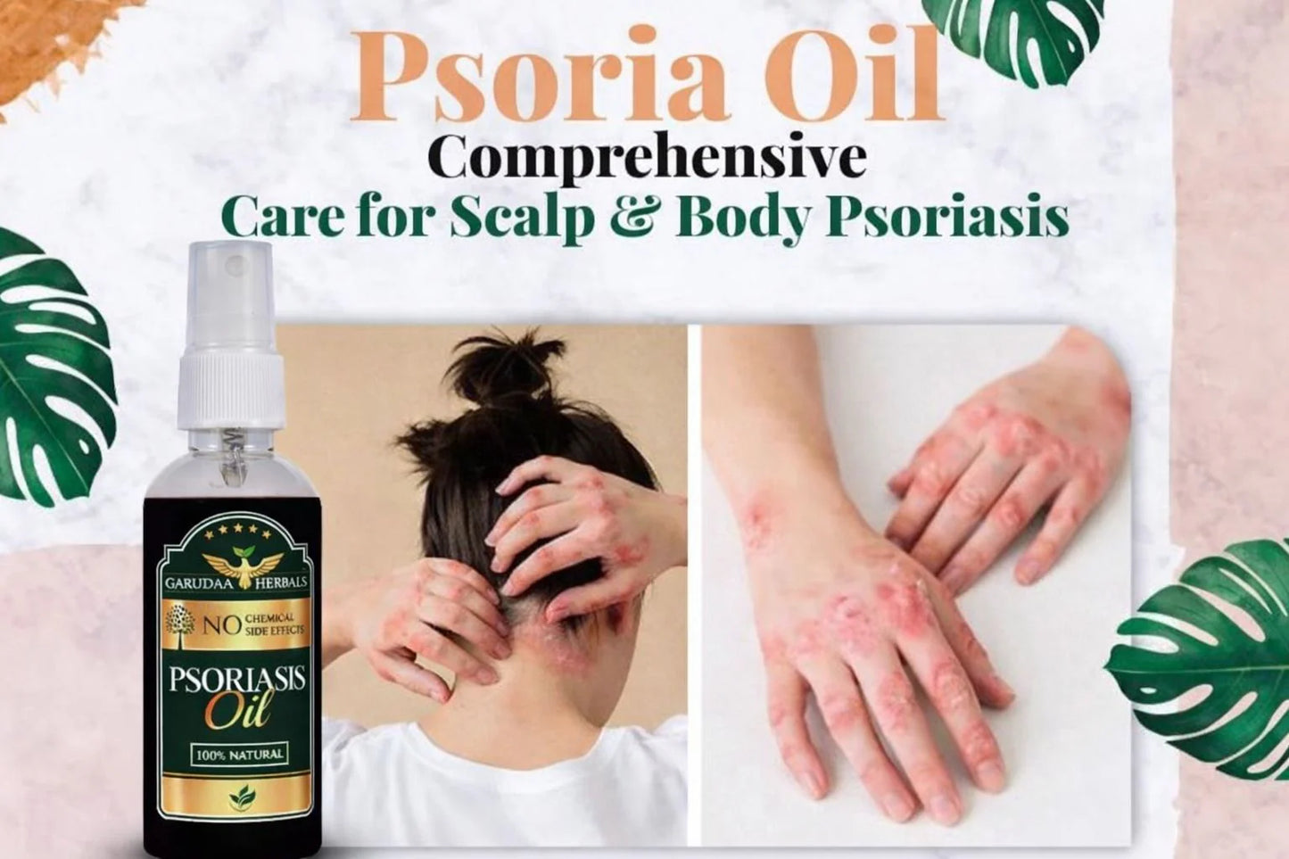 Garuda Herbal Psoriasis Oil-Advanced Psoriasis Clearing Oil With Powder